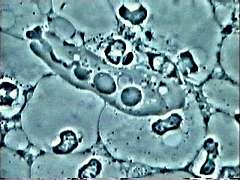 Entamoeba gongivalis