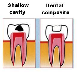 Cavity 1