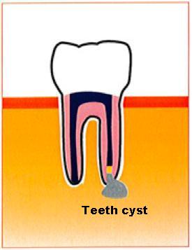 Cyst1