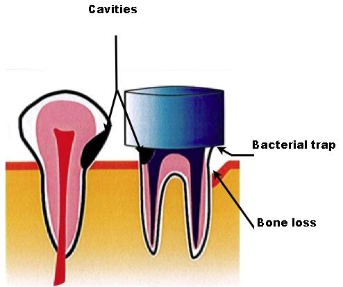 crownbacteries