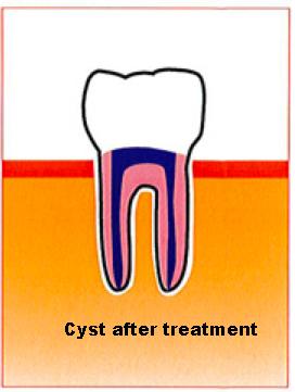 cyst 3