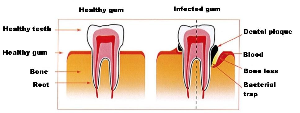 gumdesease2