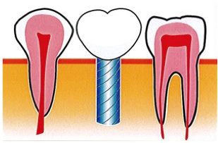 dentabsenteimplant