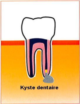 kyste 1 bis